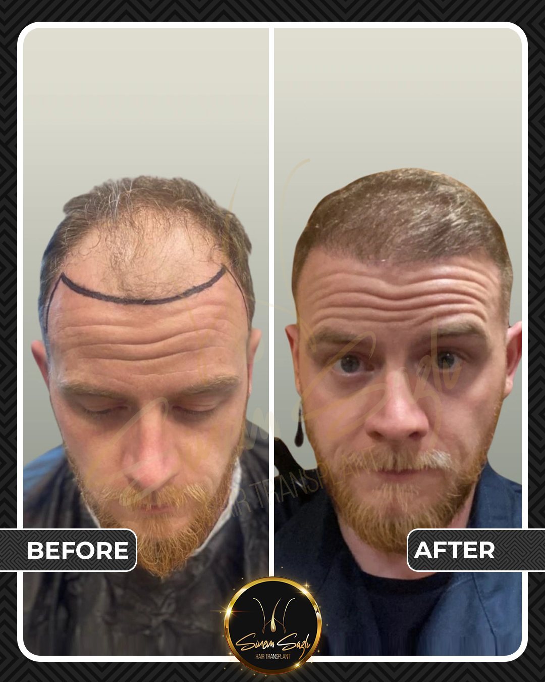 Hair Transplant before and after result
