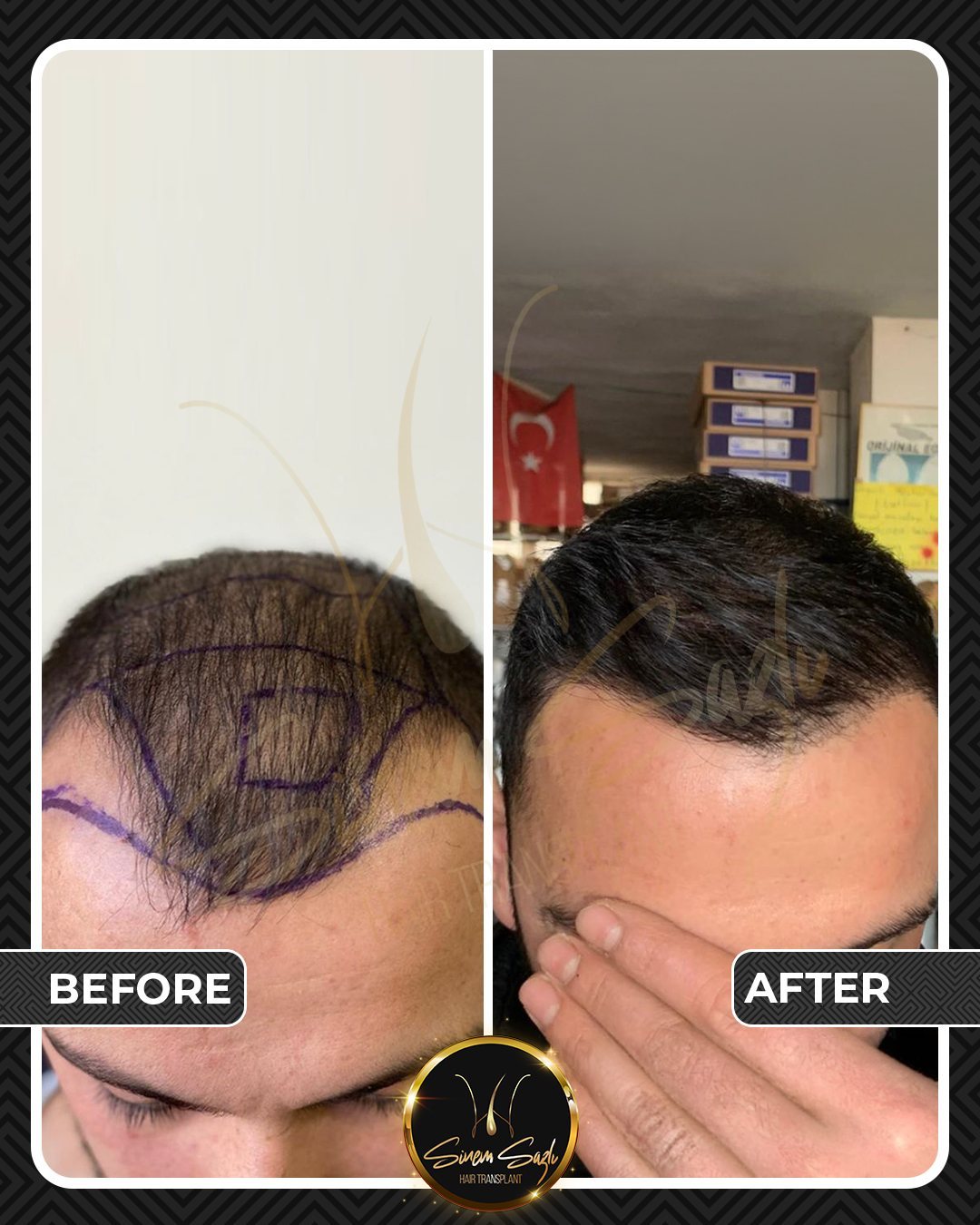 Hair Transplant before and after result