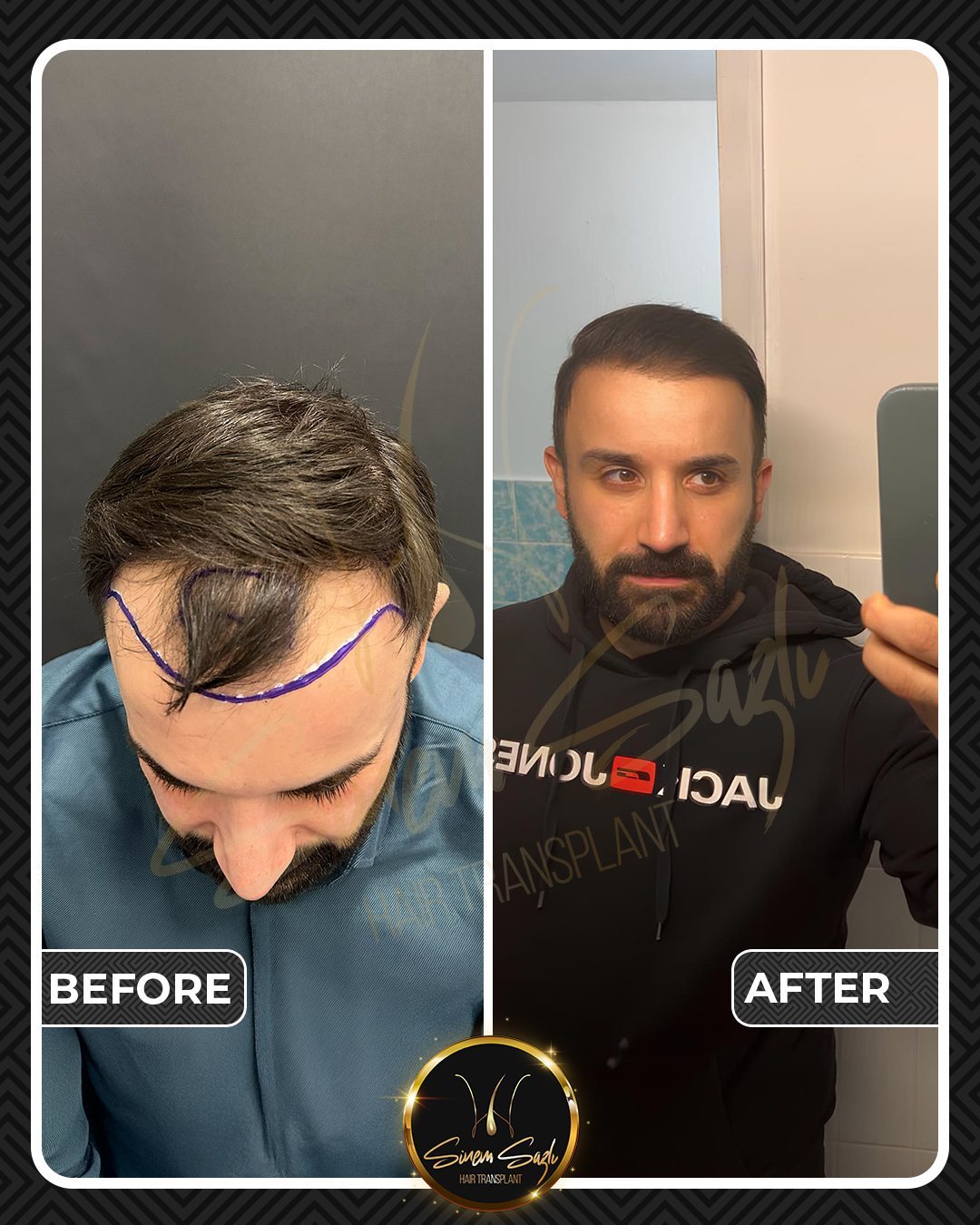 Hair Transplant before and after result