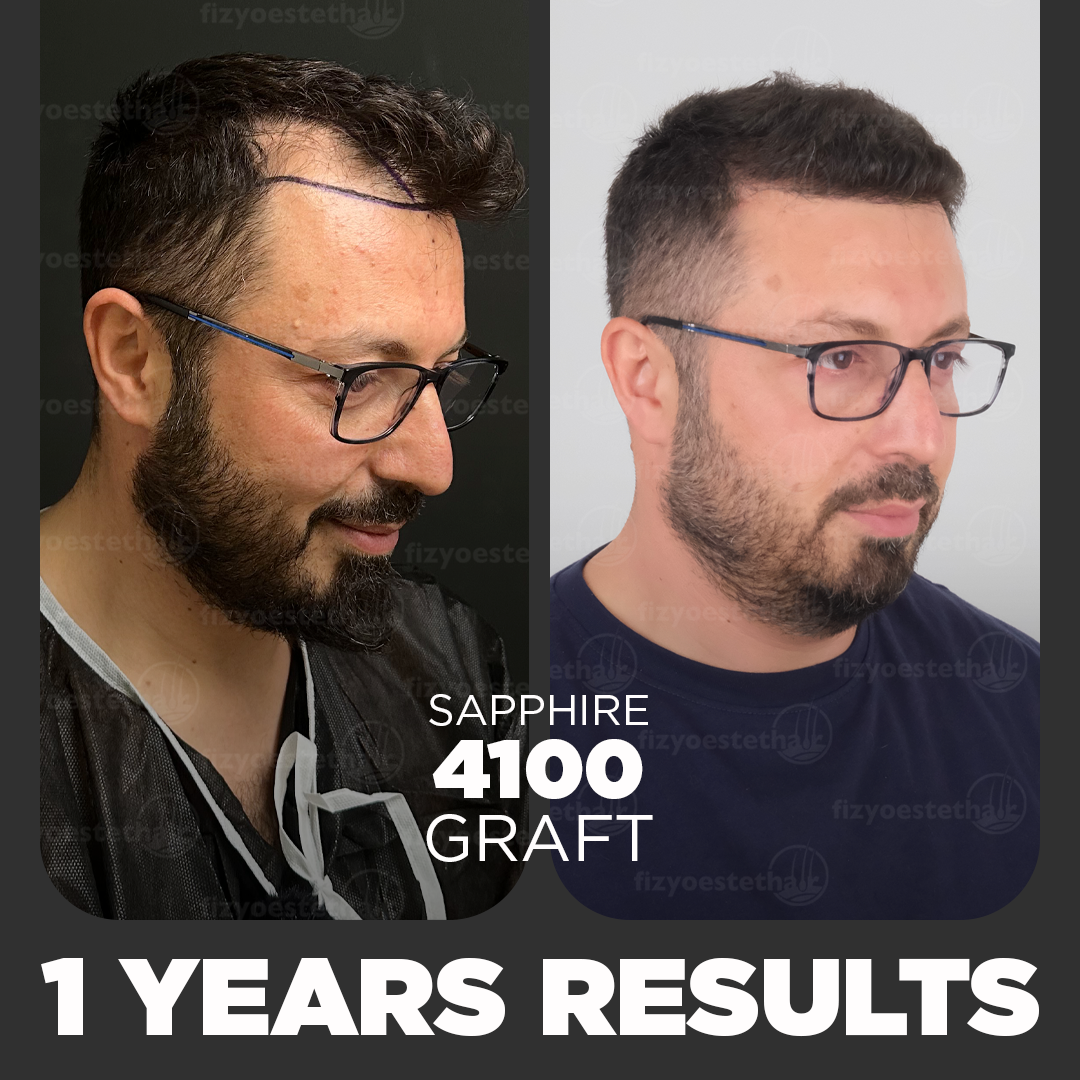 Hair Transplant before and after result