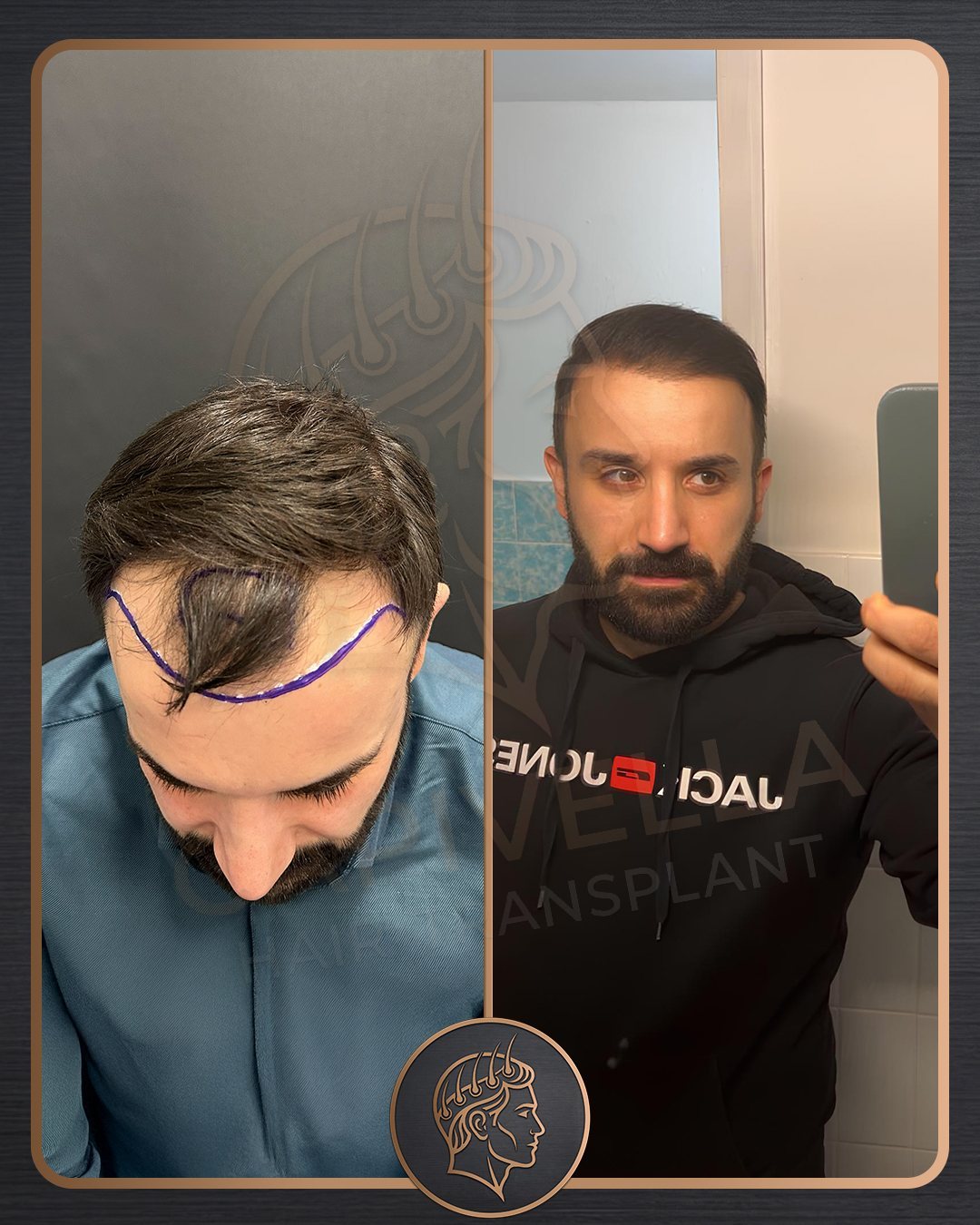 Hair Transplant before and after result