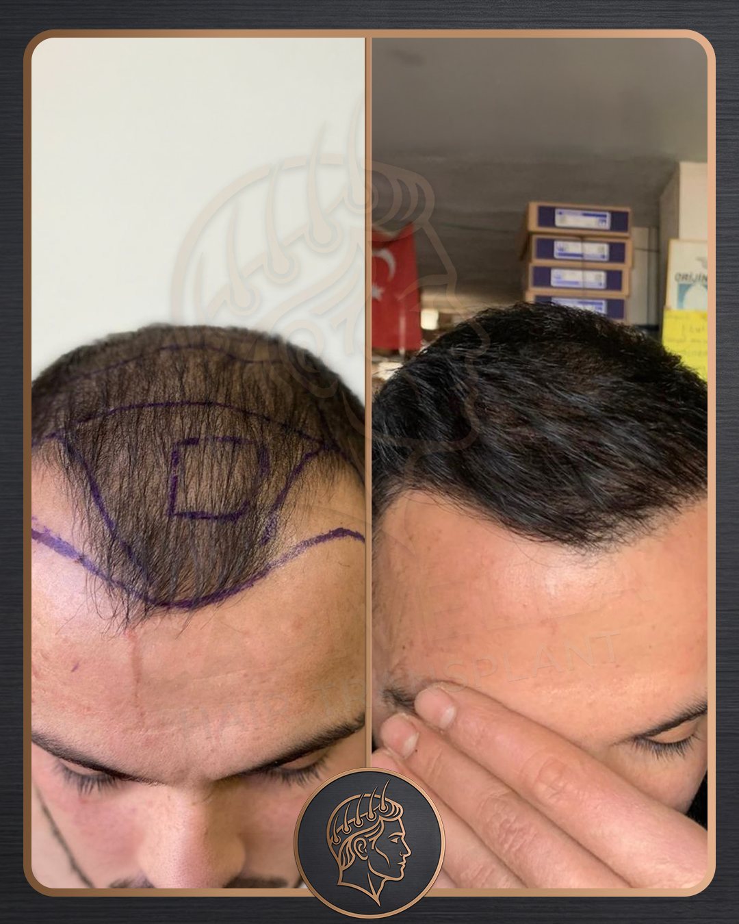 Hair Transplant before and after result