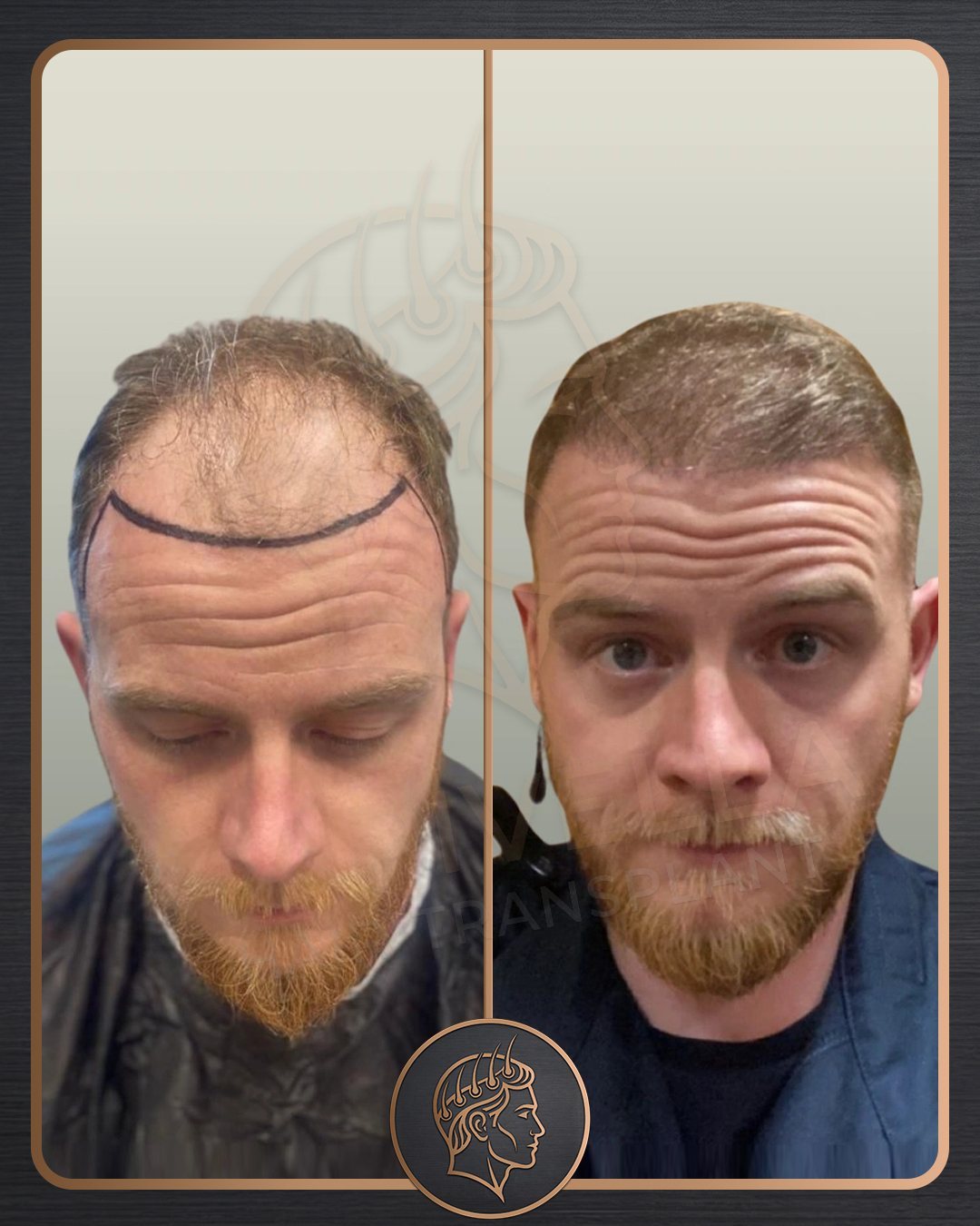 Hair Transplant before and after result